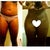better picture of hips before and after (5 weeks after surgery)