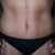 30 days PO:  Up close of my tummy!