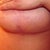 left breast is almost completely healed 7wks