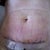 6 days post op