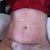6 days post op