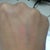 Yeah idk how this nurse missed my vein