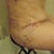 my side incision 2/2/13