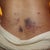 bruises from lipo....day 3