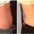 Left: Before.
Right: 8 weeks after one treatment of coolsculpting on abdomen and love handles/ flanks. As you may notice, pooch in the front of my belly is a little smaller and my tummy looks *fairly* flat.