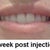 1 weeks after, they have gone down slightly but they still look fantastic!