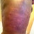 two days after cellulaze