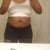 Pre-Op:  Front View 6/25/12 (7 days before op)