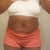 Pre-Op:  Front 6/25/12 (7 days before op)