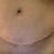 8 weeks.  Having dog ears and ends of scar lowered tomorrow in office.