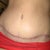 Close up of my incision, 60 days post op