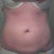 Tummy Tuck pre-surgery after weight loss