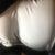 This is at 10 or 12 lbs weight loss since the surgery, this is also the side with the big bulge under my rib cage