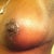 post op 21 days left breast