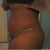 Had a Seroma here!!!Picture before having 450-600cc of fluid drawn from my stomach @ 4 weeks post op