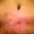 one year picture of scar from front