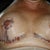 Sat 2 June Post-op day 1