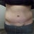 7 WEEKS POST OP Front: scar healing well. infection gone.