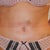 14 days post op