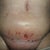 1 week post op.  Not so pretty :(
