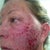 10 hours after- sweating blood, scary looking but no pain