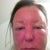 morning of day 2- extreme swelling. uncomfortable to smile or open mouth
