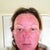 day 3 evening- slough skin off- have been using apple cider vinegar at 2- 4 hr intervals since day 1 followed by aquafor.