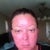 Morning of Day 4. 80% of laser skin has come off.