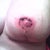 My left nipple that gave the Dr. so much trouble.  The pictures don't look good but it actually is doing great.