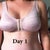 Day 1 with surgical bar on