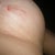 Left Breast Day 38