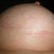 Right Breast Day 38