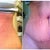 PO Day 22 - you can see the area above belly button that will have to be fixed