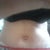 Two weeks post op. Drains removed on day 8. Kind of swollen