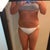 1 week post Front mostly swollen