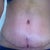 Pleased with the incision so far.  I thought the T part would be longer anyway.  Hope it eventually blends in with the other stretch marks still below BB