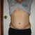 4 months post revision on left side (front View)