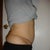 4 months post revision  on left side (right view)