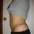 4 months post revision on left side (left view)