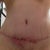 March 19, w/o the gauze