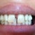 Before photo- spacing issues with front tooth shifting over a bit