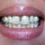 Day 2 with Invisalign appliance in, notice the spacing is kinda camoflaged! amazing!