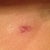 One of my incisions. Putting on my Biocorneum scar treatment cream