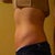 10 days after surgery