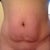 Front view, pre tummy tuck