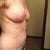 Two weeks post op.  Still some bruising where the lipo was done.