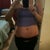 before Tummy Tuck front view
