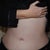 2 months, 2 weeks and 4 days post op