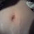 3wks 1 day po...after getting stitches out