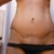 5 months PO.  TT scar.